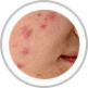 Acne Scarring