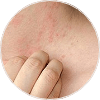 Eczema