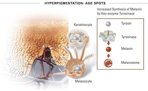 Age Spots (Liver Spots): Causes & Treatment Options