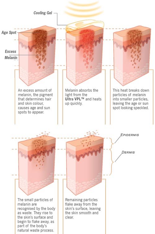 Age Spots Removal Specialists Â· Top 2017 Laser 