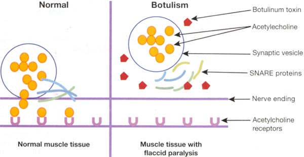 Botulinum Toxin