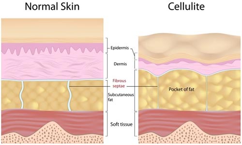 Cellulite Removal