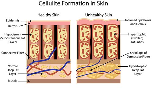 Cellulite Treatment A Laser Dermatologist NYC