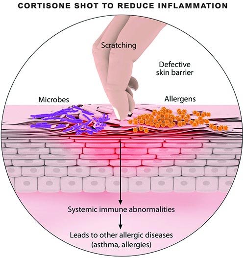 Cortisone Shots · Dermatologist NYC