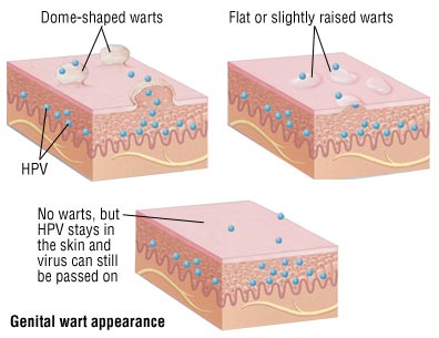 Genital Warts · Dermatologist NYC