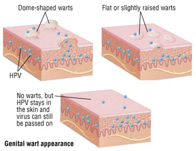 hpv warts after treatment hpv and cancer link