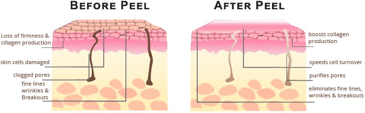 Glycolic Acid Peel NYC