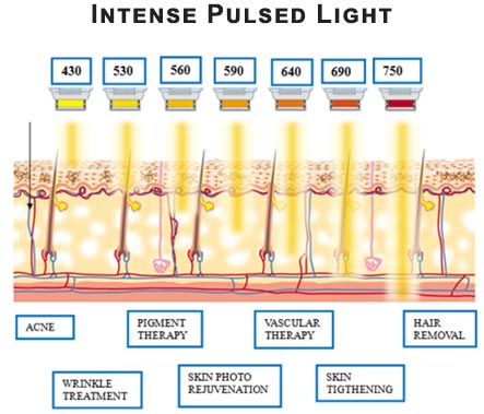 Intense Pulsed Light