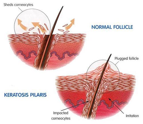 follicular hyperkeratosis face