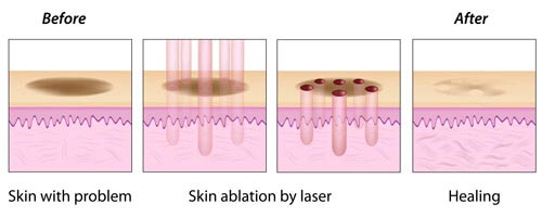 Laser Stretch Mark Removal NYC