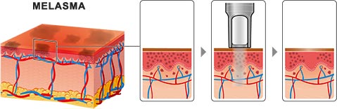 Melasma Treatment · Dermatologist NYC