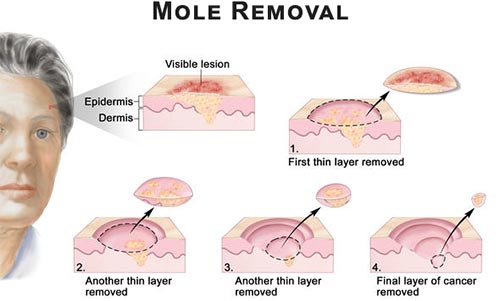 cancer removal surgery mohs skin mole treatment cell basal face carcinoma dermatologist before squamous surgical nyc patient laser definition treated