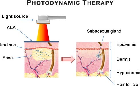 Photodynamic Therapy · Dermatologist NYC