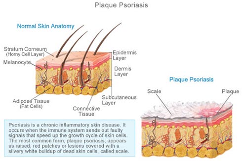 Plaque Psoriasis · Dermatologist NYC