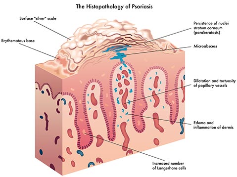 The Histopathology of Psoriasis