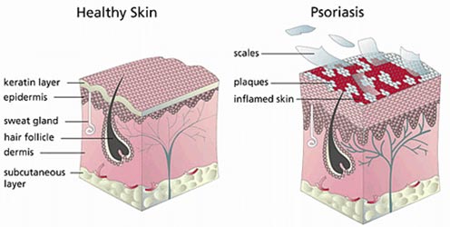 dermatologist psoriasis)