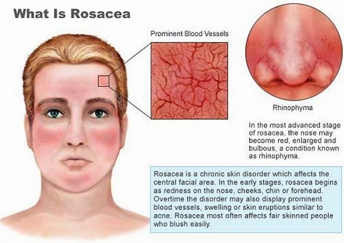 Rosacea Dermatologist NYC