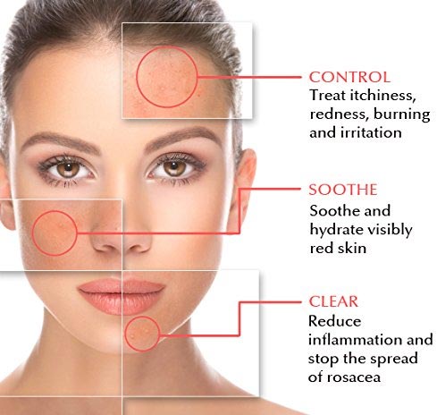 Fremme medarbejder Markeret Rosacea Natural Treatment · Top Dermatology · Dermatologist NYC