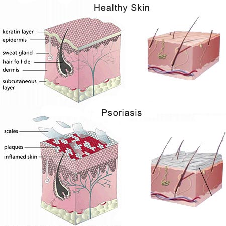 dermatologist psoriasis vörös kerek durva folt a karon