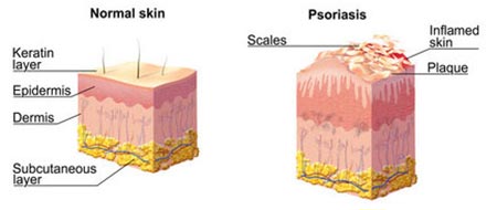 Scalp Psoriasis Treatment NYC