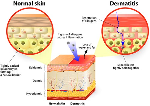 Seborrheic Dermatitis Specialist - Laser Dermatology 