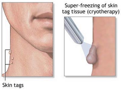 Skin Tag Removal Specialist NYC