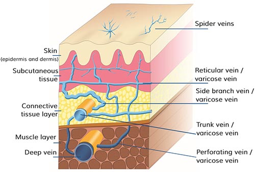 Spider Veins