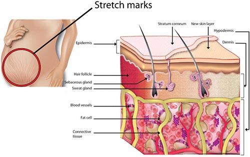 Stretch Marks Causes & Treatments NYC