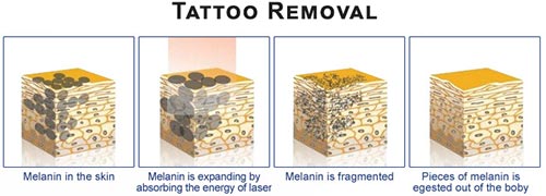 Tattoo Removal in NYC