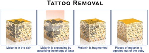 Tattoo Removal Business Draws Up HighGrowth Potential