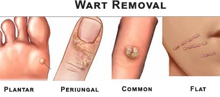 Wart Removal · Dermatologist NYC