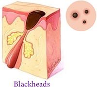 Blackheads Acne Dermatology Manhattan NYC