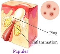 Papules Acne Dermatology Manhattan NYC