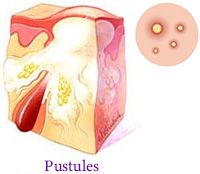 Pustules Acne Dermatology Manhattan NYC