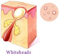 Whiteheads Acne Dermatology Manhattan NYC