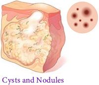 Cysts Acne Nodulescne Dermatology Manhattan NYC