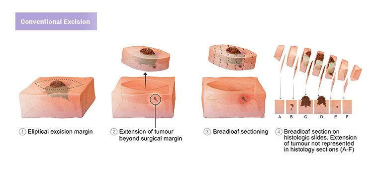 Conventional Excision for Skin Cancer