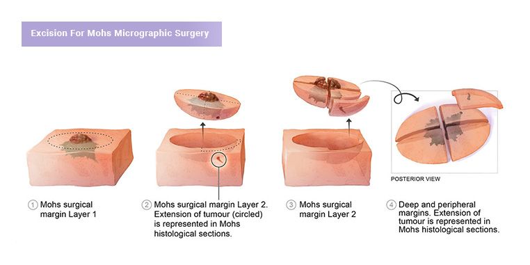 Mohs Surgery in NYC