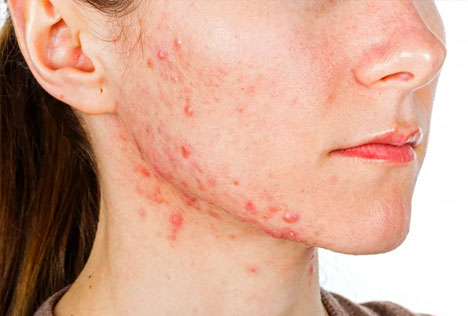 acne condition