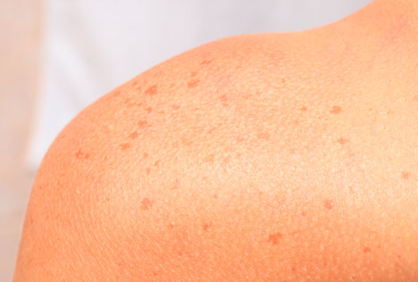 Brown Spots - Mayoral Dermatology