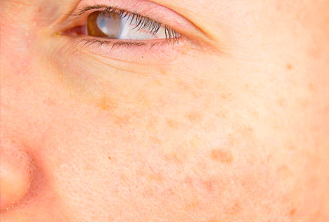 age spots removal